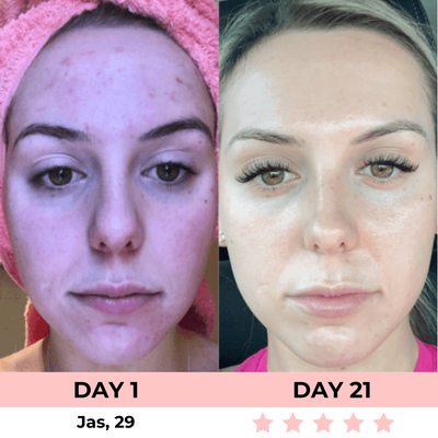 LumiLift LED Facial Sculptor