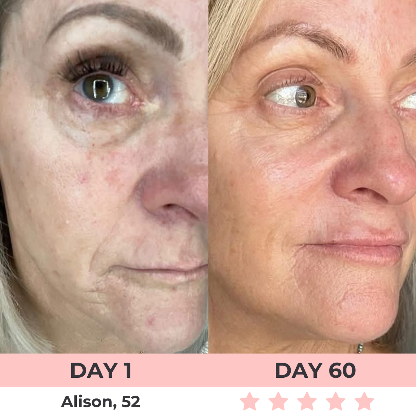 LumiLift LED Facial Sculptor
